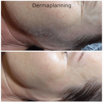 Dermaplanning